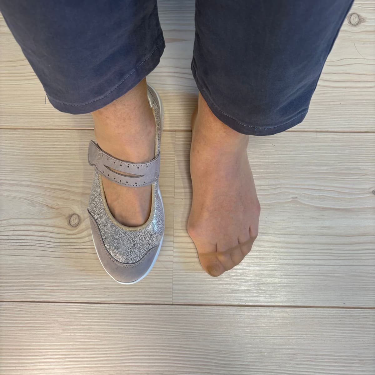Hallux valgus fotografie