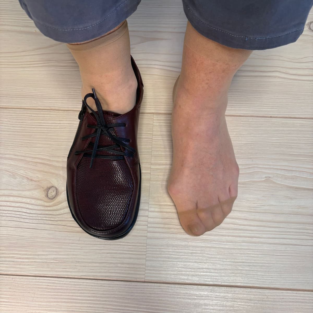 Hallux valgus fotografie