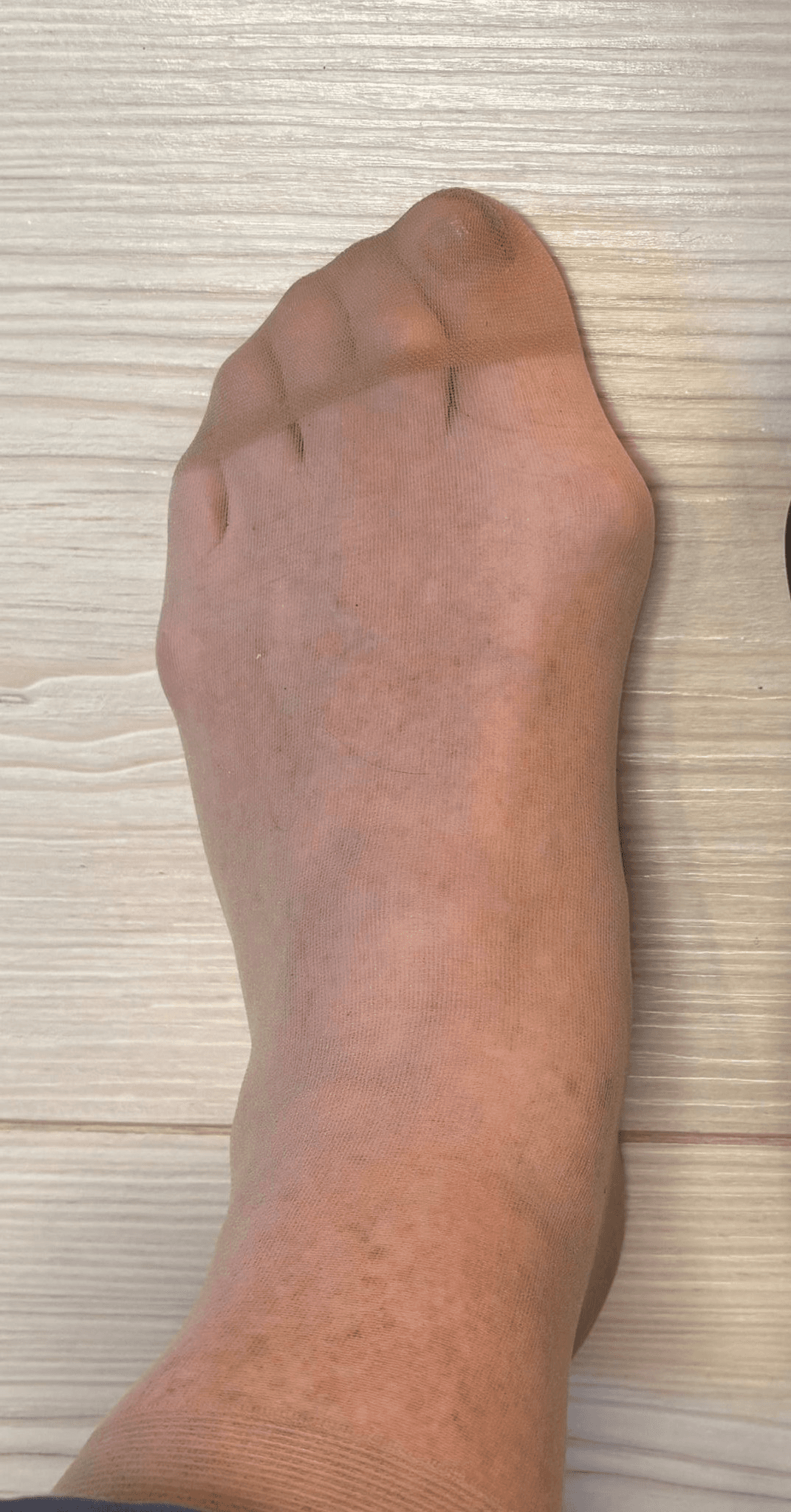 Hallux valgus ilustrace